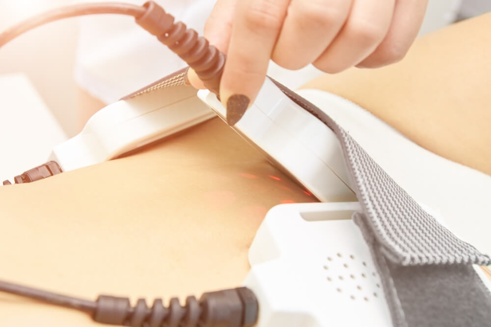 lipolaser - efekty po 6 zabiegach na oponkę na brzuchu lipolaser - efekty po 6 zabiegach na dolnej części brzucha